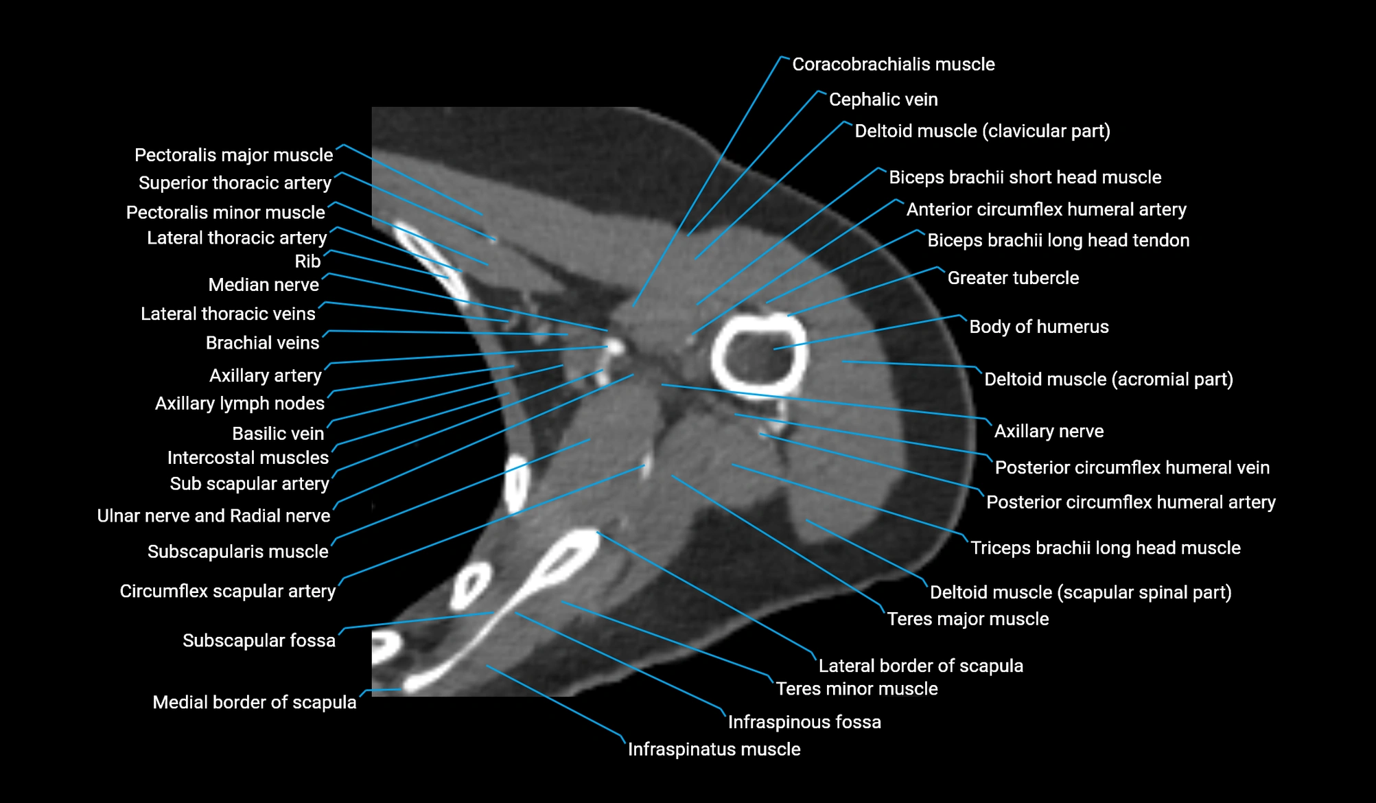 CT upper arm axial  cross sectional anatomy labelled radiology image -00128.webp